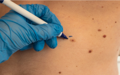 Don’t Wait – Get Your Skin Checked Today! Skin Cancer Can Happen to Anyone