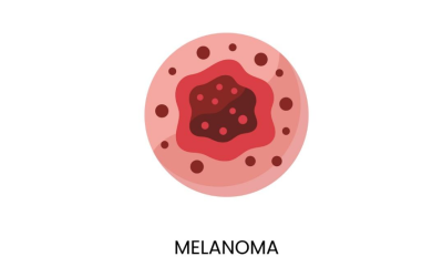 Early Skin Cancer Detection Saves Lives, A Patient’s Journey with Melanoma in Situ